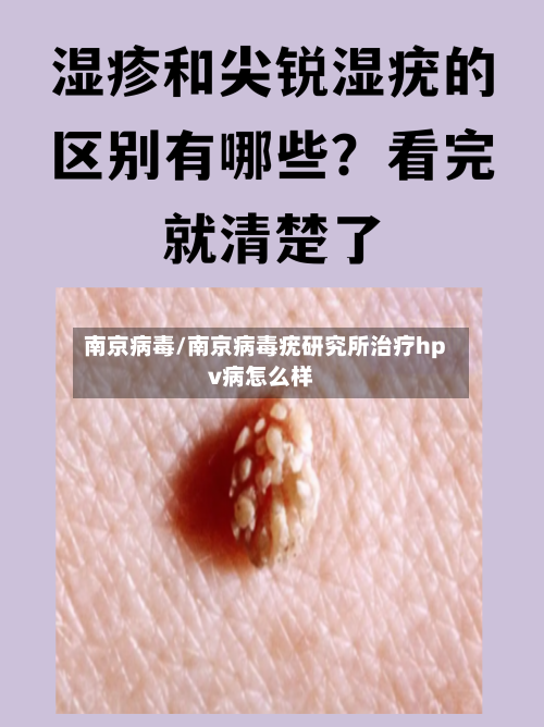 南京病毒/南京病毒疣研究所治疗hpv病怎么样