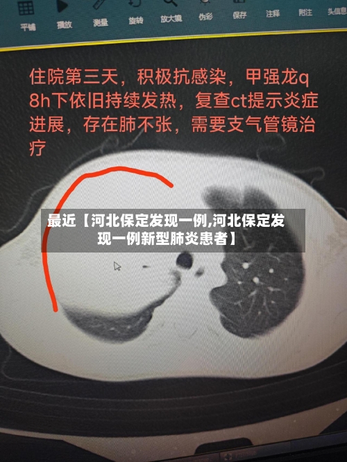 最近【河北保定发现一例,河北保定发现一例新型肺炎患者】