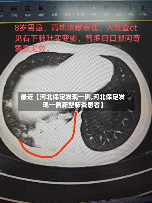 最近【河北保定发现一例,河北保定发现一例新型肺炎患者】-第2张图片