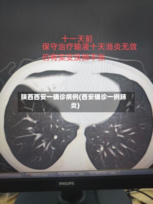 陕西西安一确诊病例(西安确诊一例肺炎)-第3张图片