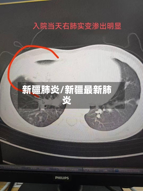 新疆肺炎/新疆最新肺炎-第3张图片