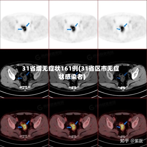 31省增无症状161例(31省区市无症状感染者)