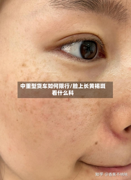 中重型货车如何限行/脸上长黄褐斑看什么科-第2张图片