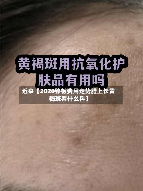 近来【2020镍板费用走势脸上长黄褐斑看什么科】